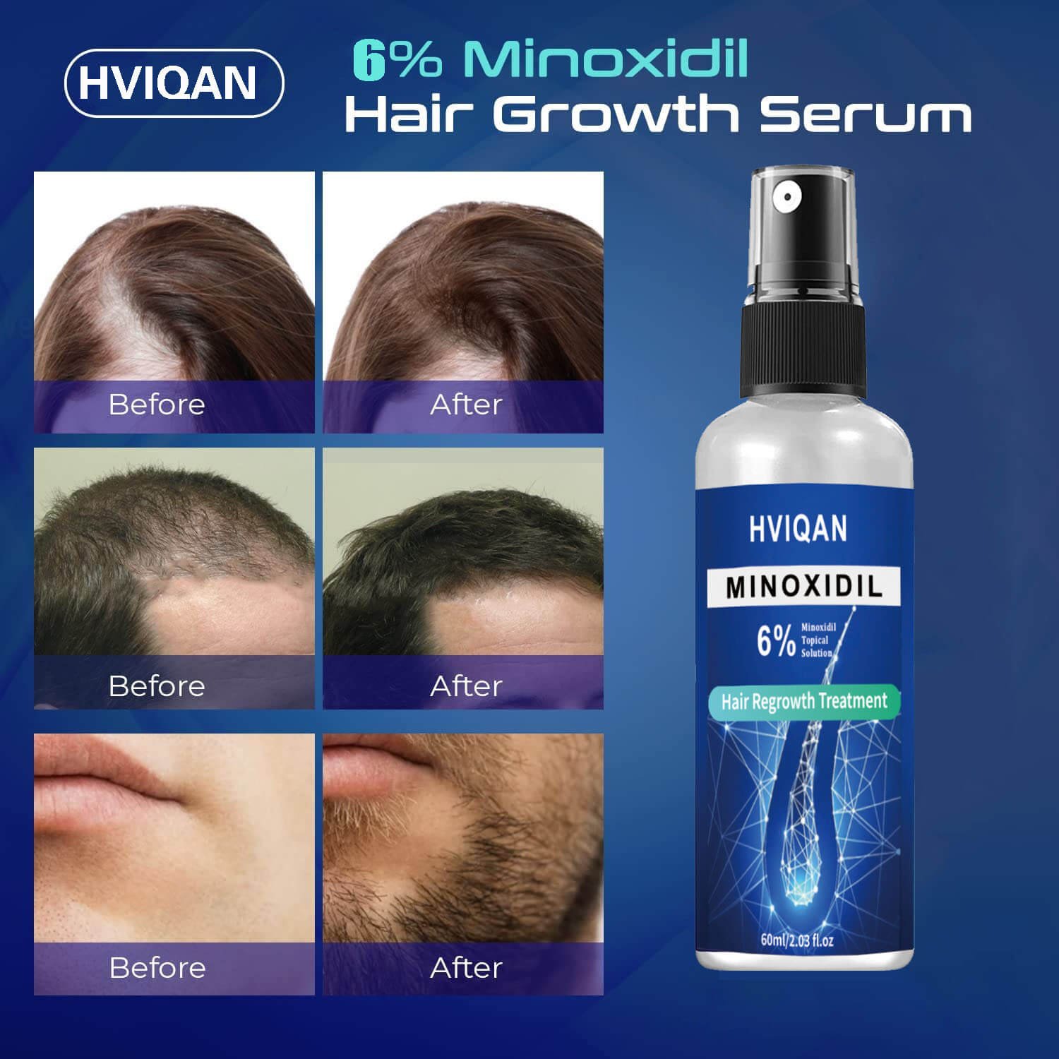 minoxidil shampoo for men
