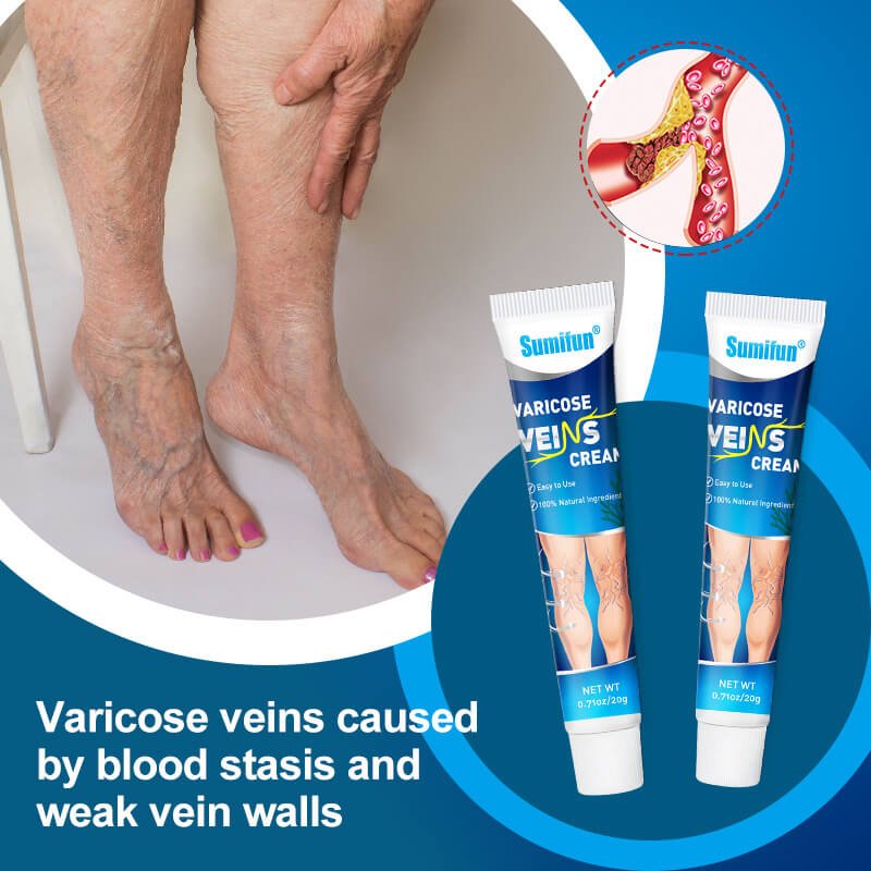 when to worry about varicose veins